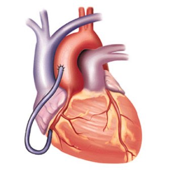 heart_stent_niharonline